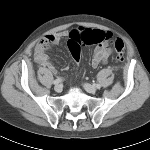 Acute pancreatitis and walled-off necrosis (Radiopaedia 29888-30403 Axial C+ delayed 64).jpg