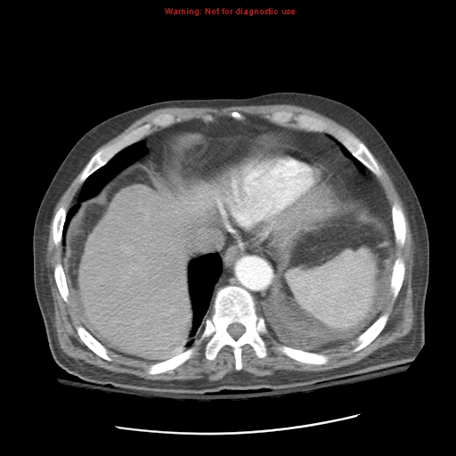 Acute pancreatitis with incidental pancreatic lipoma (Radiopaedia 10190-10730 Axial C+ arterial phase 14).jpg
