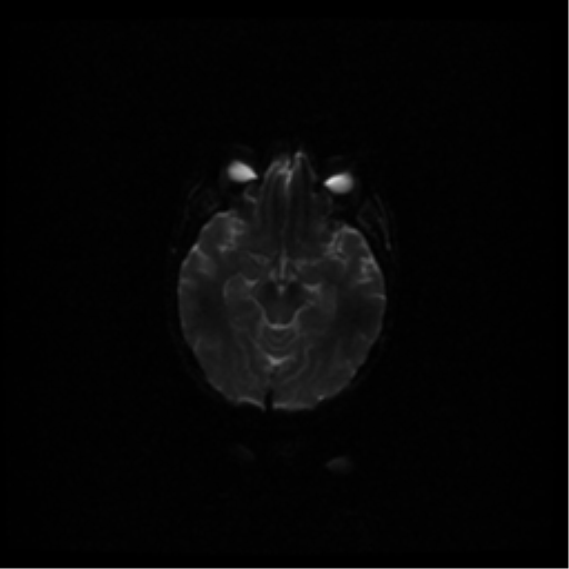 File:Acute pontine infarct from vertebral artery dissection (Radiopaedia 34111-35370 Axial DWI 33).png