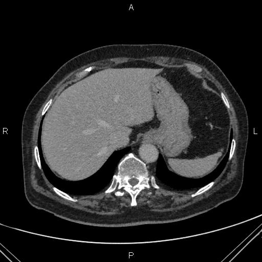 Acute renal artery occlusion (Radiopaedia 86586-102682 Axial C+ delayed 8).jpg