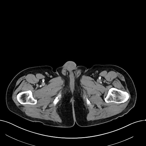 Acute renal infarction (Radiopaedia 59375-66736 Axial C+ portal venous phase 136).jpg