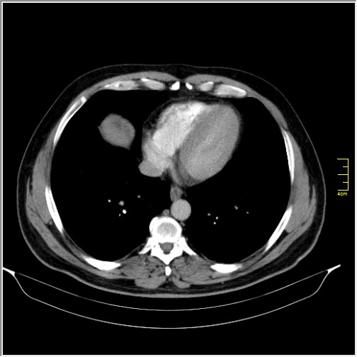 File:Acute right sided diverticulitis (Radiopaedia 65249-74268 Axial C+ portal venous phase 1).JPG