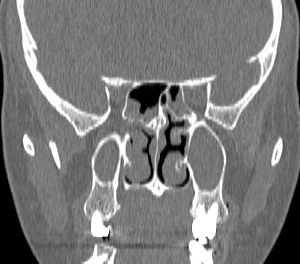 Acute sinusitis (Radiopaedia 40564-43158 Coronal bone window 30).jpg