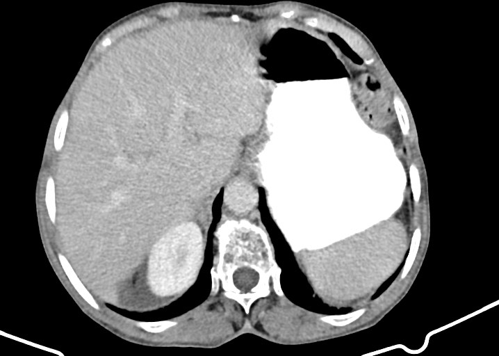Acute small bowel (ileal) volvulus (Radiopaedia 71740-82139 Axial C+ portal venous phase 56).jpg