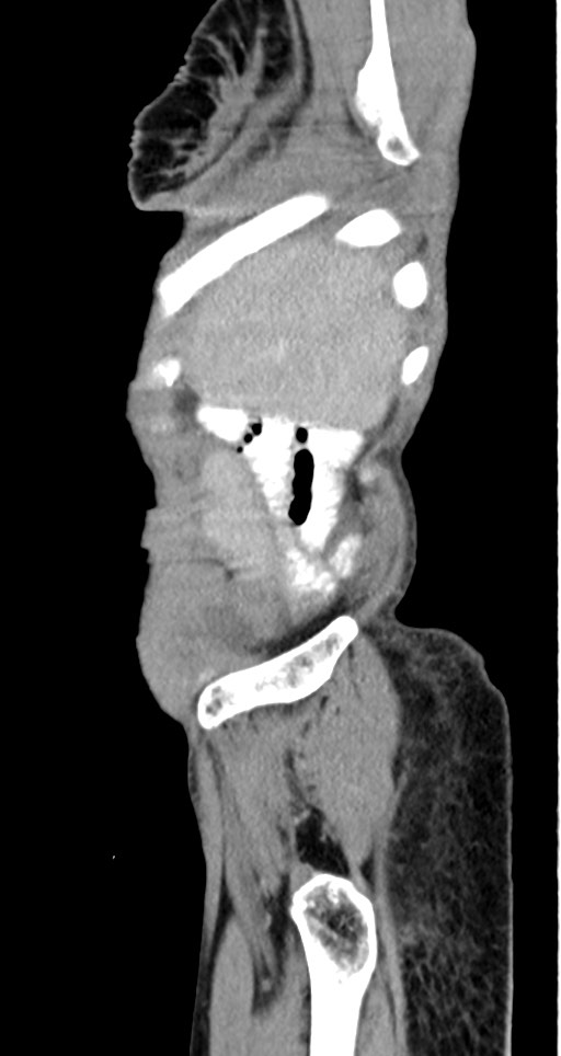 Acute small bowel (ileal) volvulus (Radiopaedia 71740-82139 Sagittal C+ portal venous phase 144).jpg