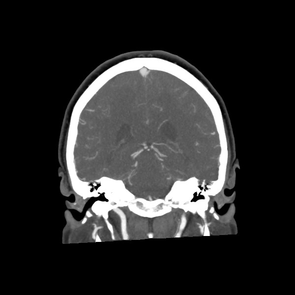 Acute subarachnoid hemorrhage and accessory anterior cerebral artery (Radiopaedia 69231-79009 Coronal C+ arterial phase 51).jpg