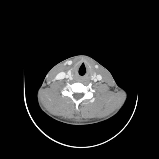 File:Acute submandibular sialadenitis secondary to ductal stone (Radiopaedia 27999-28267 Axial C+ delayed 34).jpg