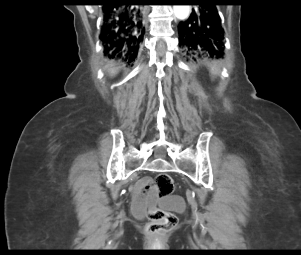 File:Acute superior mesenteric artery occlusion (Radiopaedia 43926-47418 Coronal C+ portal venous phase 40).png