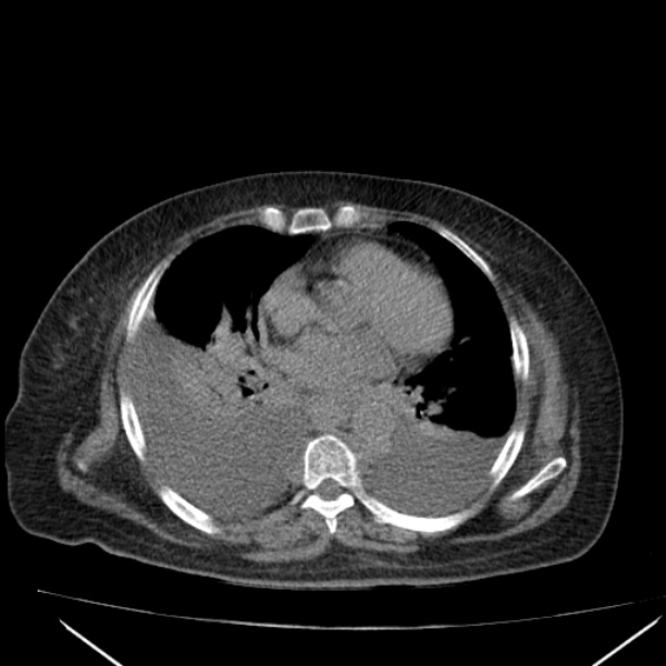 Acute tubular necrosis (Radiopaedia 28077-28334 Axial non-contrast 1).jpg