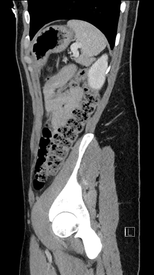 Acute uncomplicated appendicitis (Radiopaedia 61374-69304 Sagittal C+ portal venous phase 23).jpg