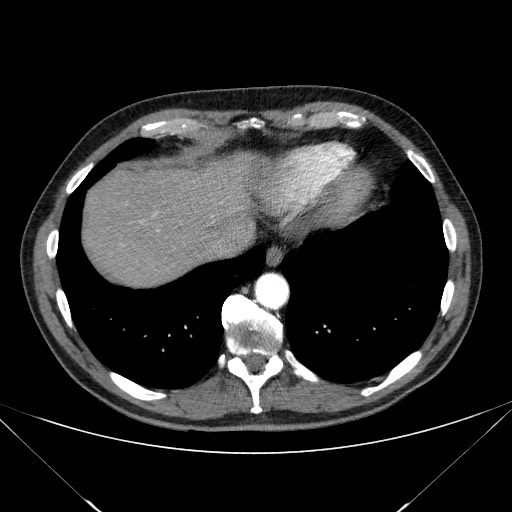 File:Adenocarcinoma of the lung (Radiopaedia 59871-67325 Axial C+ arterial phase 76).jpg