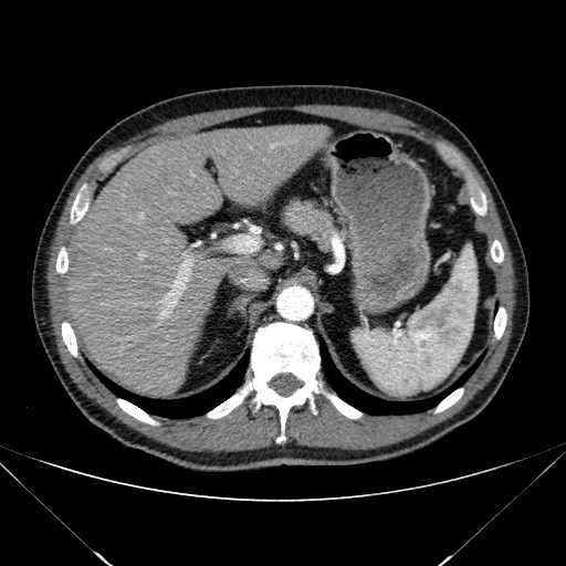 File:Adenocarcinoma of the lung (Radiopaedia 59871-67325 Axial C+ arterial phase 93).jpg