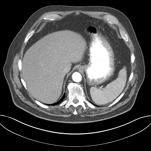 Adenocarcioma of rectum- T1 lesion (Radiopaedia 36921-38547 Axial C+ arterial phase 49).png