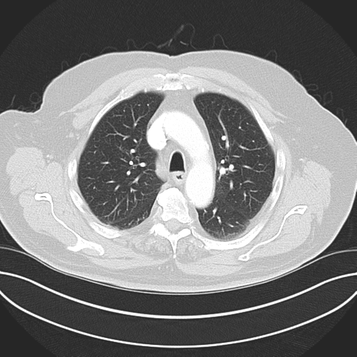 Adenocarcioma of rectum- T1 lesion (Radiopaedia 36921-38547 Axial lung window 20).png