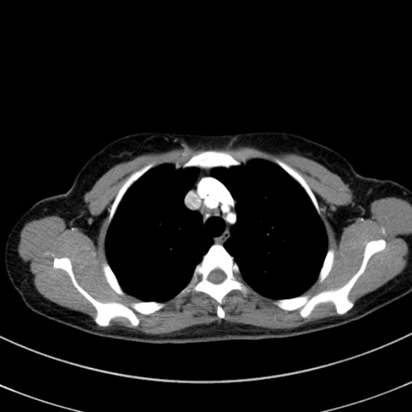 Adenocystic carcinoma of the trachea (Radiopaedia 47677-52525 Axial C+ arterial phase 38).jpg