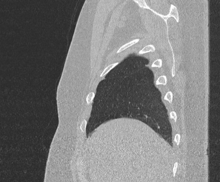 Adenoid cystic carcinoma of the trachea (Radiopaedia 49042-54137 Sagittal lung window 66).jpg