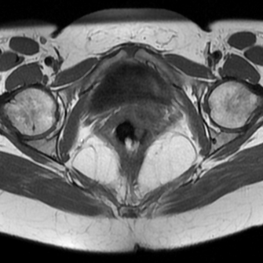 File:Adenoma malignum of cervix (Radiopaedia 66441-75705 Axial T1 14).jpg