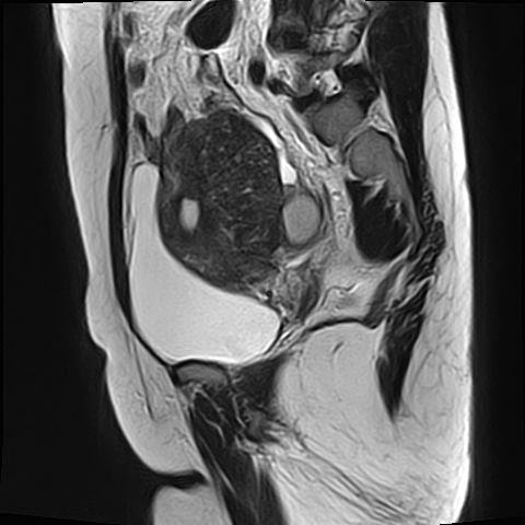 File:Adenomyosis - ovarian endometriomas (Radiopaedia 67031-76350 Sagittal T2 17).jpg