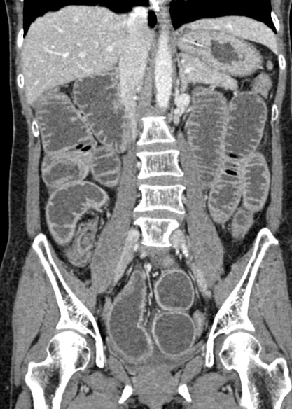 Adhesional small bowel obstruction (Radiopaedia 48397-53305 Coronal C+ portal venous phase 192).jpg