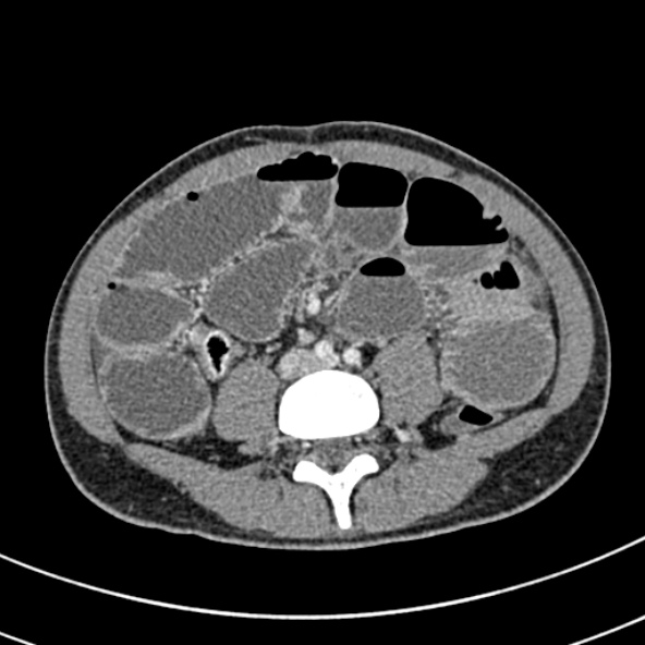 Adhesional small bowel obstruction (Radiopaedia 52107-57980 Axial C+ portal venous phase 76).jpg