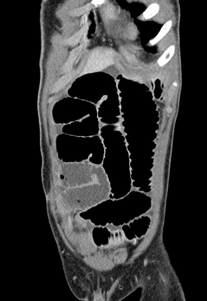 Adhesional small bowel obstruction (Radiopaedia 52107-57980 Coronal C+ portal venous phase 12).jpg