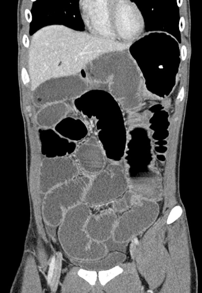 Adhesional small bowel obstruction (Radiopaedia 52107-57980 Coronal C+ portal venous phase 22).jpg