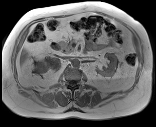 File:Adrenal cortical carcinoma (Radiopaedia 64017-72770 Axial T1 in-phase 38).jpg