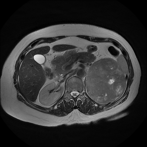 File:Adrenal cortical carcinoma (Radiopaedia 70906-81116 Axial T2 15).jpg