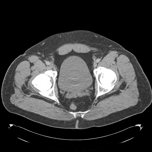 Adrenal cyst (Radiopaedia 45625-49776 Axial C+ portal venous phase 92).png