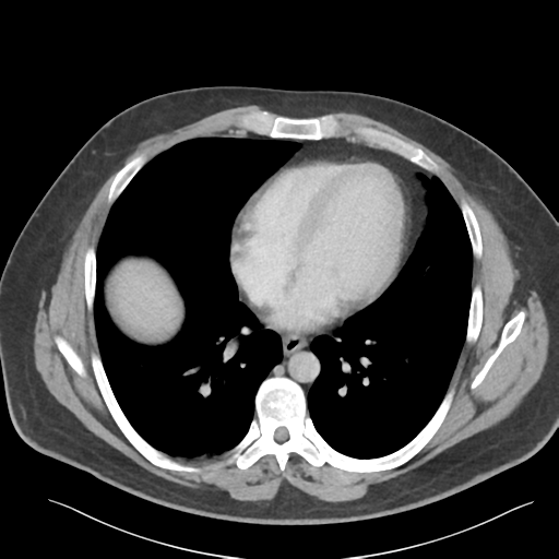 File:Adrenal cyst (Radiopaedia 45625-49777 Axial C+ portal venous phase 8).png