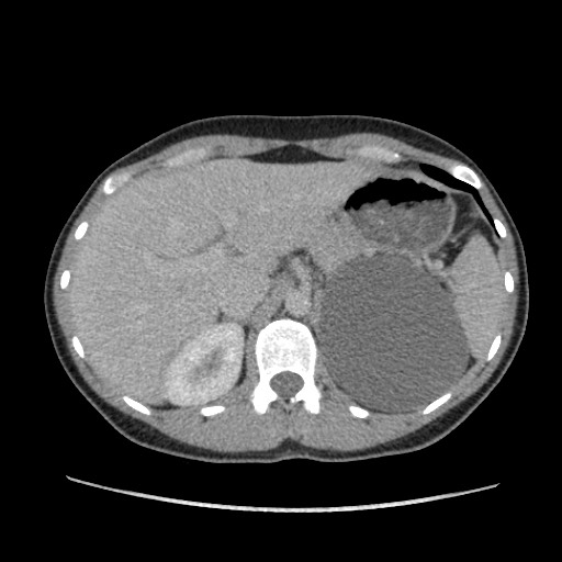 Adrenal cyst (Radiopaedia 64869-73813 Axial C+ portal venous phase 21).jpg