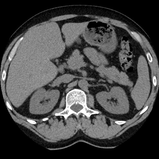Adrenal gland trauma (Radiopaedia 81351-95079 Axial non-contrast 37).jpg