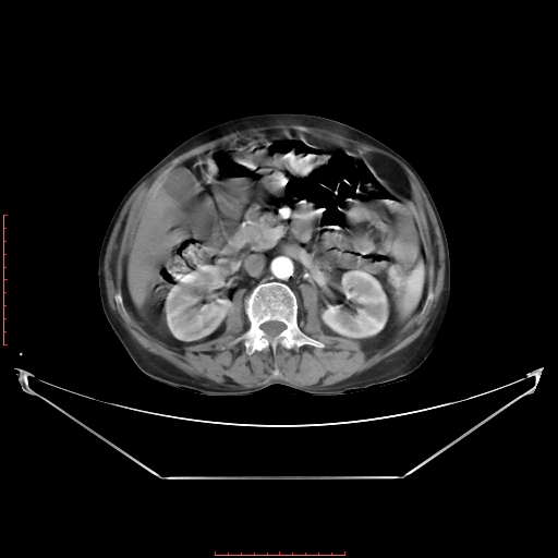 Adrenal hemangioma (Radiopaedia 68923-78668 Axial C+ arterial phase 35).jpg