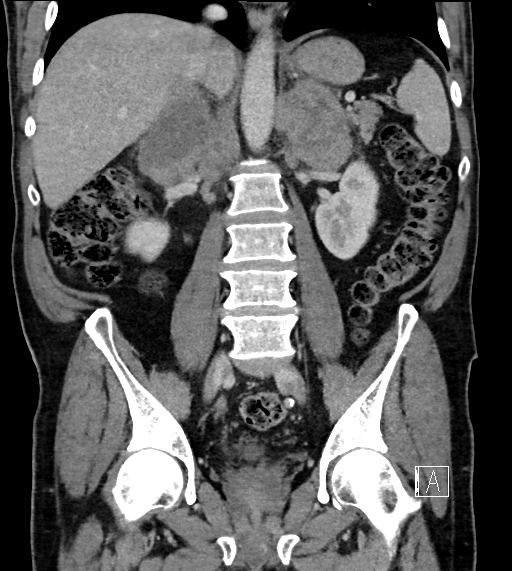 Adrenal lymphoma (Radiopaedia 73730-84529 Coronal C+ portal venous phase 47).jpg