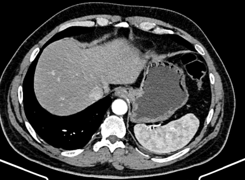 Adrenal metastases (Radiopaedia 73082-83791 Axial C+ arterial phase 21).jpg