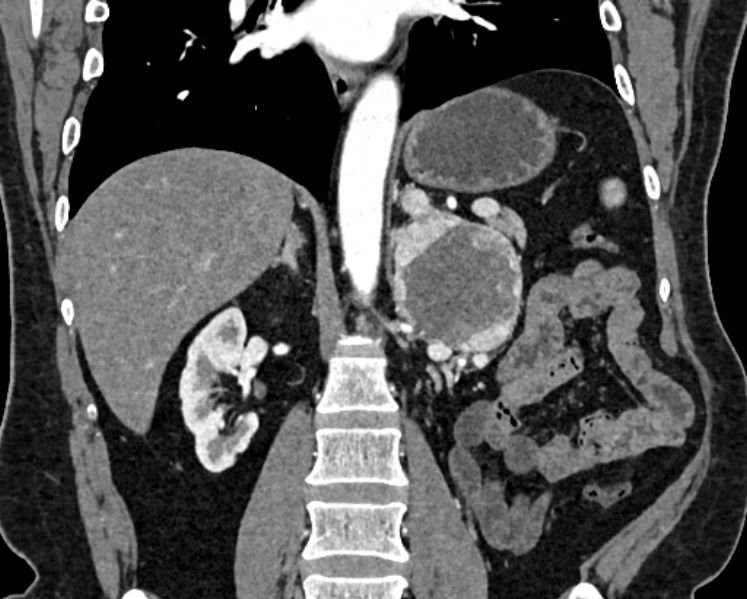 Adrenal metastases (Radiopaedia 73082-83791 Coronal C+ arterial phase 37).jpg