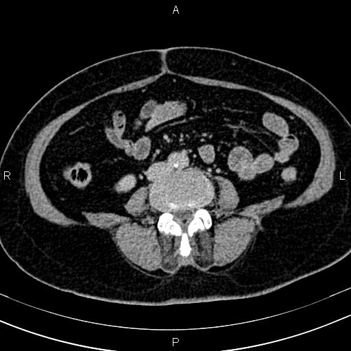 Adrenal myelolipoma (Radiopaedia 82742-96986 Axial renal excretory phase 93).jpg