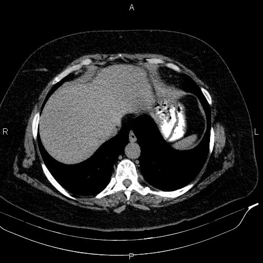 Adrenal myelolipoma (Radiopaedia 84319-99617 Axial With oral contrast 28).jpg