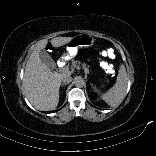 Adrenal myelolipoma (Radiopaedia 84319-99617 Axial With oral contrast 64).jpg