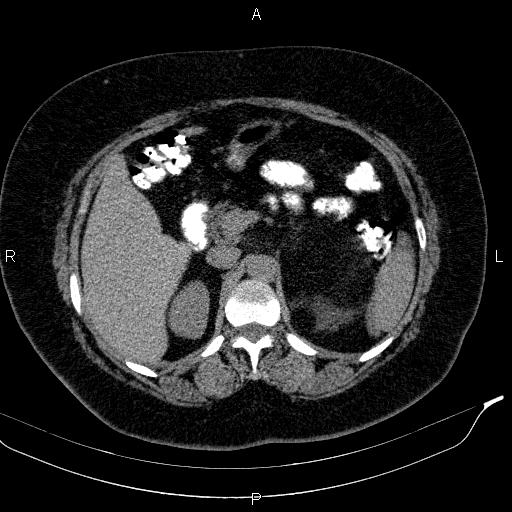 Adrenal myelolipoma (Radiopaedia 84319-99617 Axial With oral contrast 73).jpg