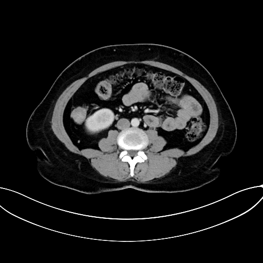Adrenocortical carcinoma (Radiopaedia 87281-103569 Axial C+ portal venous phase 49).jpg