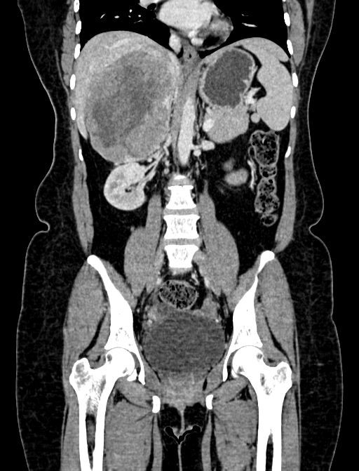 Adrenocortical carcinoma (Radiopaedia 87281-103569 Coronal C+ portal venous phase 59).jpg