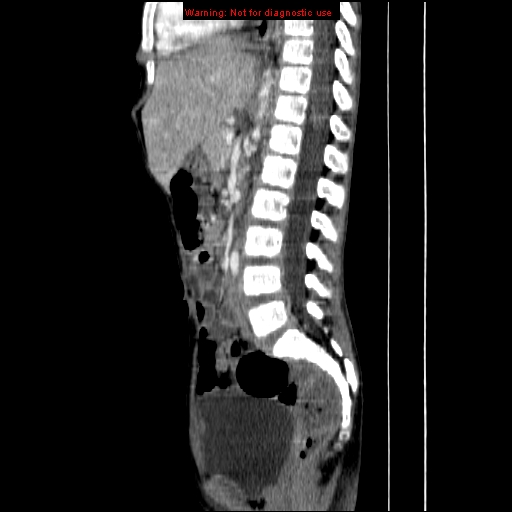File:Adrenocortical carcinoma (Radiopaedia 9449-10131 Sagittal C+ portal venous phase 6).jpg