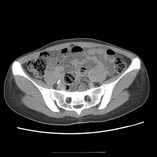 File:Adult polycystic kidney disease (Radiopaedia 48845-53876 Axial renal excretory phase 70).jpg
