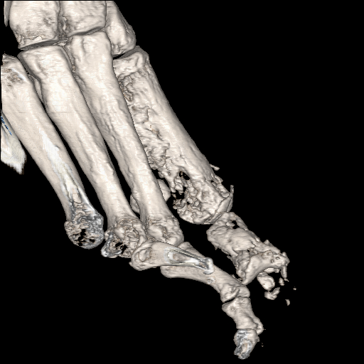 File:Advanced osteomyelitis due to open metatarsal fracture (Radiopaedia 83891-99095 VRT 18).jpg