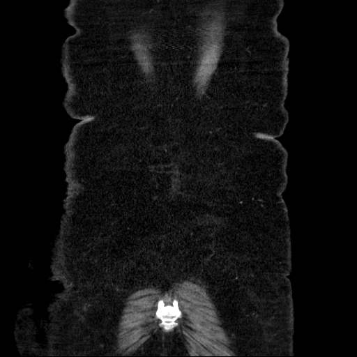 File:Afferent loop syndrome - secondary to incarcerated trocar site hernia (Radiopaedia 82959-97305 Coronal C+ portal venous phase 136).jpg