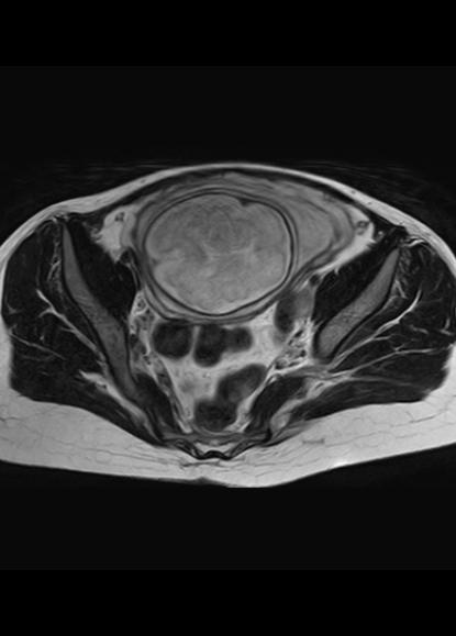 File:Aggressive angiomyxoma of the pelvis and perineum (Radiopaedia 59162-66479 Axial T2 16).jpg