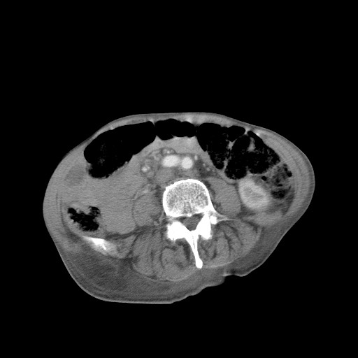 File:Aggressive lung cancer with cardiac metastases, pulmonary artery tumor thrombus, and Budd-Chiari (Radiopaedia 60320-67981 A 78).jpg