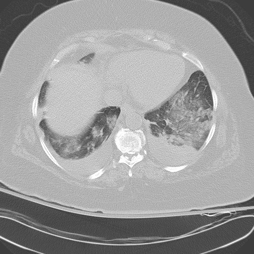 All trans retinoic acid (ATRA) syndrome (Radiopaedia 38212-40229 Axial lung window 41).jpg