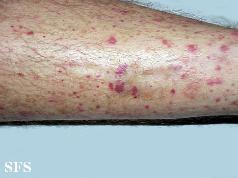 Allergic Vasculitis (Dermatology Atlas 2).jpg